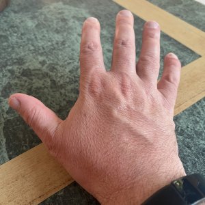 17 - thankfully not my drinking arm