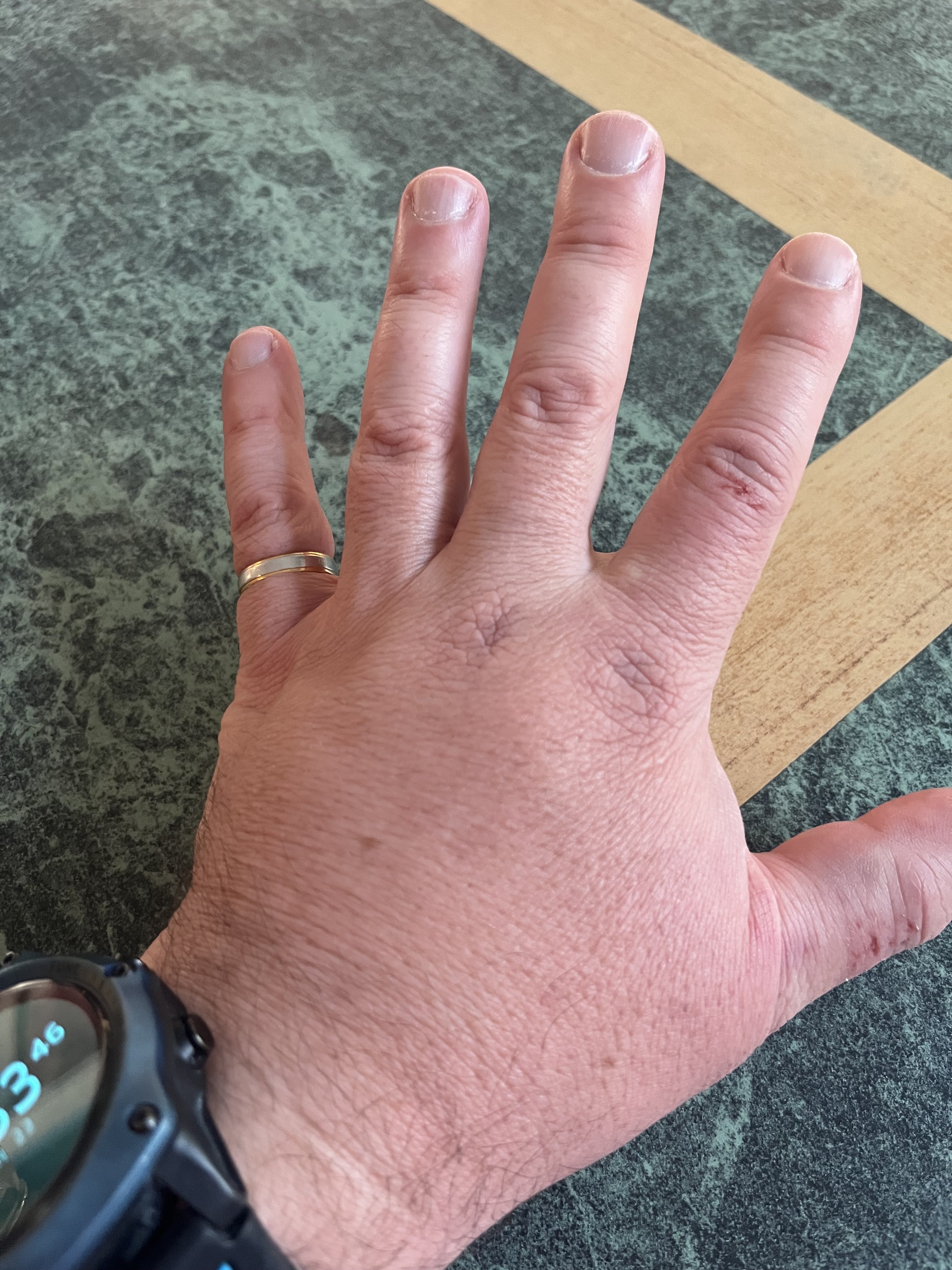 16 - Cracked a bone slipping at the diveshop